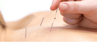 dry needling, physiotherapy, physio near me, physio adelaide