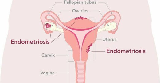 Endometriosis_2